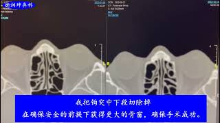 切除钩突的鼻腔泪囊吻合术