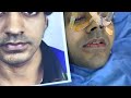 Jaw Surgery Transformation - Before after results | Richardson Face Hospitals