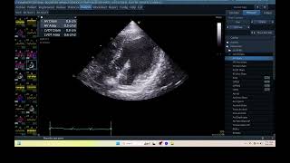 IQ 345 HEMODYNAMIC ECHOPAC ANALYSIS ECHOCARDIOGRAPHY 1