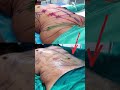 | How Dr. Amit Gupta Design Six Pack Abs | Plastic Surgeon in Delhi