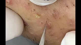 Shocking Cystic Blackheads \u0026 Whiteheads Extraction Revealed / new blackheads this week 12-308