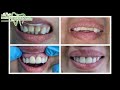 Zirconia veneers Smile Makeover Hollywood Smile | Hassaan Dental Clinic