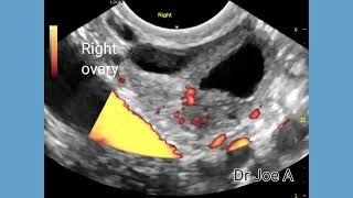 PCOD, polycystic ovaries or normal, a diagnostic dilemma, Ultrasound and color Doppler video