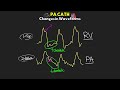 changes to our pa catheter waveforms and values