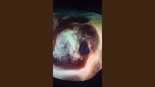 Secundum Atrial Septal Defect (3D TEE)