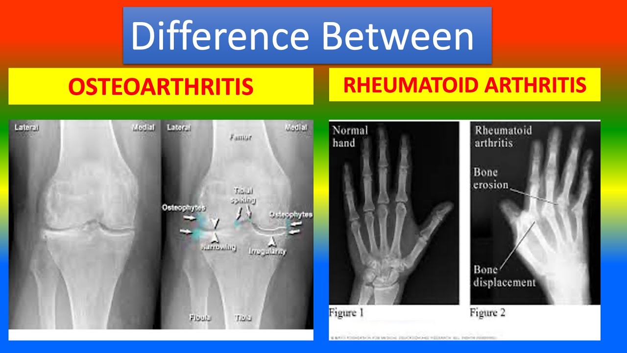 Osteoarthritis Vs Rheumatoid Arthritis Hands