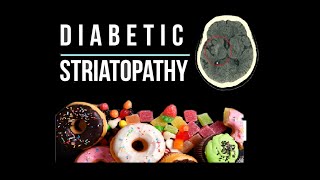 Diabetic striatopathy /Non-ketotic hyperglycemic hemichorea