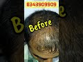 PRP Hair LossTreatment Before And After | #ytshorts #shorts