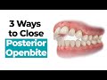 3 Ways to Close a Posterior Openbite https://www.straightsmilesolutions.com/