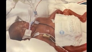 Baby born at 5 months when mom put him in her lap she was shocked