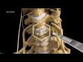 c5-c6-c7 Anterior Cervical Discectomy with Fusion