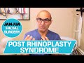 POST RHINOPLASTY SYNDROME - DR. TANVEER JANJUA - NEW JERSEY