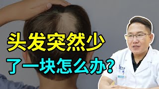 【脱发问答】出现俗称“鬼剃头”的“斑秃”怎么办？三个月是分界线！雍禾植发|马晓阳医师