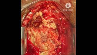 HGY : Pericardite Purulente âgée de 04 ans: diagnostic et prise en charge