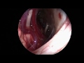 hemifacial spasm – endoscope assisted microvascular decompression