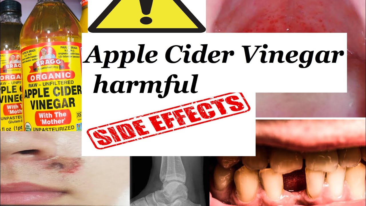 SIDE EFFECTS OF APPLE CIDER VINEGAR - YouTube