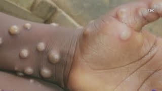 Stigma of Monkeypox wrongfully attached to LGBTQ+ community