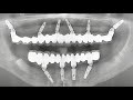 S.I.N Implant EPIKUT double arch, step by step. @sinimplantsystem