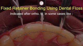 Bonding fixed permanent retainer in orthodontics with dental floss Asker Orthodontics (twist flex)