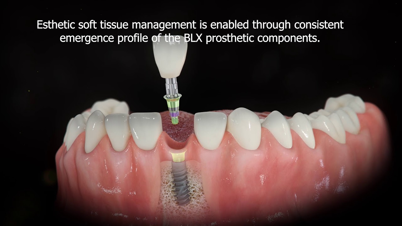 Straumann® BLX Implant System - Consistent Emergence Profile - YouTube