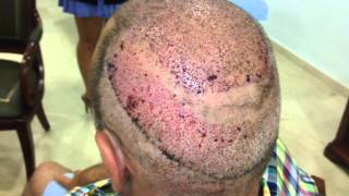 Hair Transplant Dr. Panno´s exclusive Tricomplete technique more than 7000 grafts or 17500 hairs