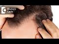 Can biotin supplements lead to hairfall & its role in hair regrowth? - Dr. Harish Prasad B R