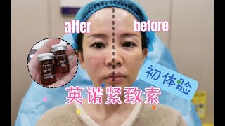 【医美实拍】英诺紧致素初体验！五点定位smile打法，法令纹直接不见？