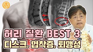 허리디스크와 협착증의 차이 | 만성 퇴행성 디스크 | 허리디스크는 수술해야하는 질병? | X-ray로 디스크와 협착증을 알 수 있을까? | 허리에 치명적인 진공 청소기?