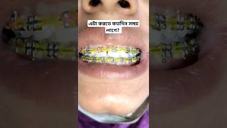 এই ট্রিটমেন্ট করতে কত সময় লাগে? খরচ কত?  #dental #orthodontictreatment