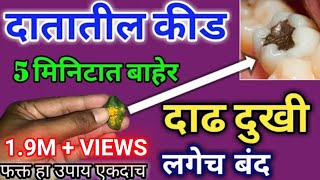 दातातील कीड 5 मिनिटात बाहेर | दाढ दुखी साठी घरगुती उपाय | dental caries home remedy | डॉ तोडकर उपाय