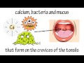 How to get rid of tonsil stones fast How to get rid of tonsil stones fast