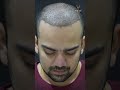 hair restoration results post 10 days of hair transplant treatment hair transplant in ahmedabad