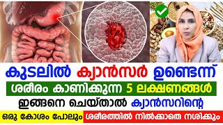 കുടൽ കാൻസർ ശരീരത്തിൽ ഉണ്ടെന്ന് കാണിക്കുന്ന 5 ലക്ഷണങ്ങൾ. ഇങ്ങനെ ചെയ്താൽ കാൻസർ കോശങ്ങൾ നശിക്കും |