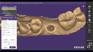 Implant Model design #dentium superline in #exocad #dental #implant @rho_hitdent