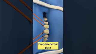 Facetas de resina composta com preparo dental ✅ #dentista #dentes #facetas