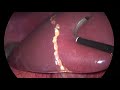 Laparoscopic Right Hepatectomy  Ligasure crushing technique