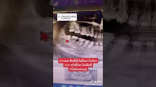 ผ่าฟันคุดกับถอนฟันคุด ต่างกันอย่างไง