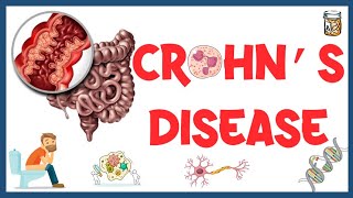 Crohn's Disease : Causes, Pathogenesis, Clinical Presentation, Diagnosis & Treatment