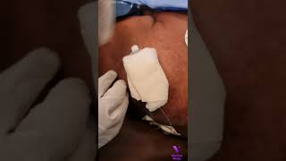 Technique of Epidural Anesthesia