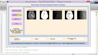 Brain Tumor Detection (Watershed Technique) Using Matlab