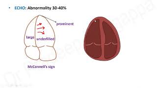 Pulmonary Embolism   | Dr. Pradeep Rangappa