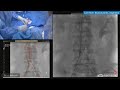 Bilateral Percutaneous EVAR Using Minos Ultra Low-Profile EVAR Endograft In Calcified Renal Arteries