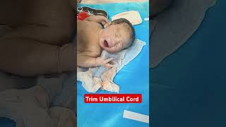 Trim Umbilical cord after birth newborn baby 😍🍼 #cutebaby #baby #crying #shorts #viral #newborn