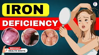 10 Weird Signs You're Low on Iron | Iron Deficiency Anemia | Iron Deficiency Symptoms