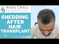 Hair transplant in indore | Shedding after Hair Transplant