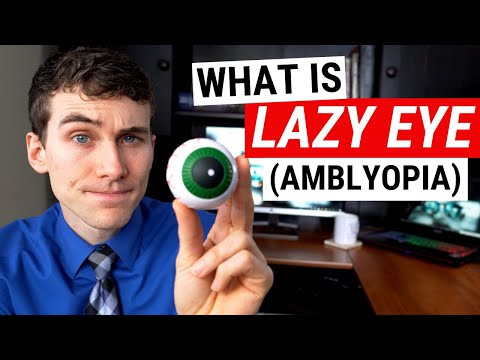 Does lazy eye cause monocular vision?