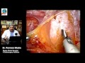 Digital CME on Risk Reduction Strategies in Laparoscopic Ventral Hernia Repair -Dr. Parveen Bhatia