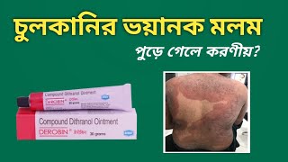 DEROBIN: Most dangerous antifungal cream