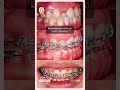 GiO Orthodontic: Memperbaiki Crossbite Anterior