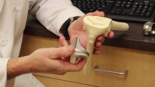 How is a total knee replacement performed?